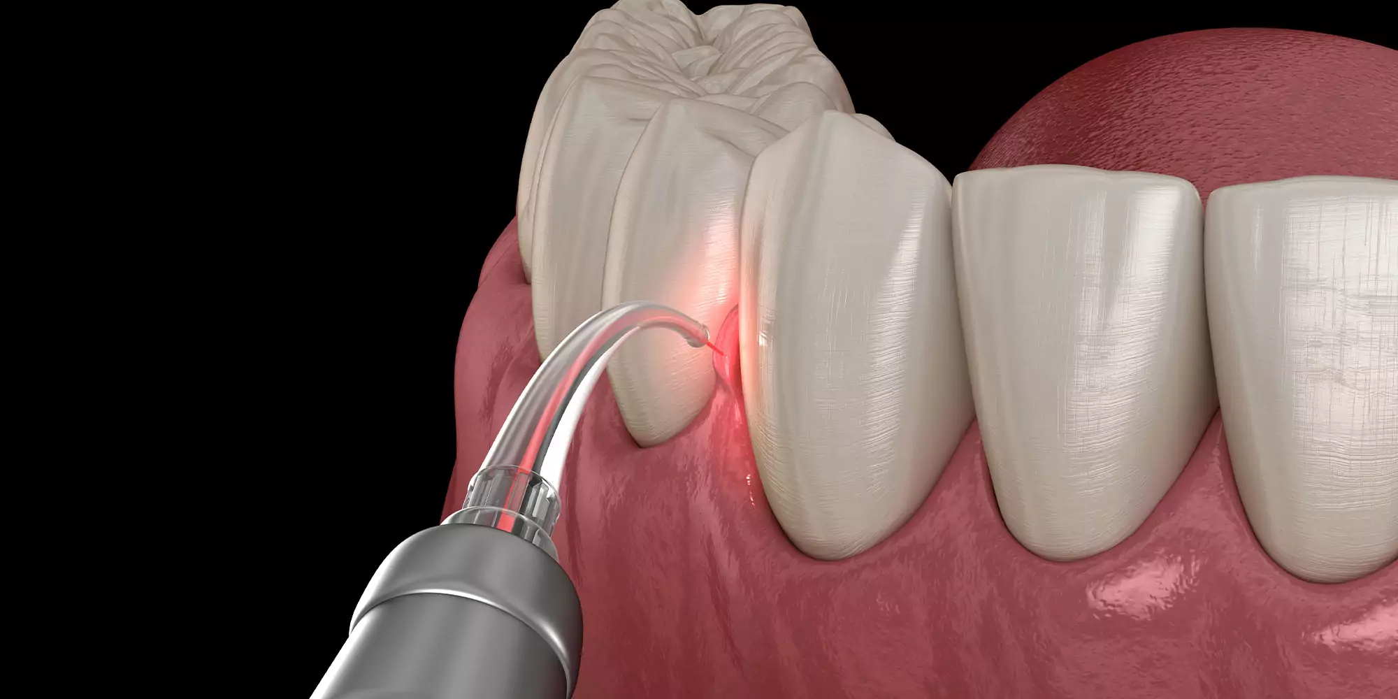 BLAST Implant Protocol
